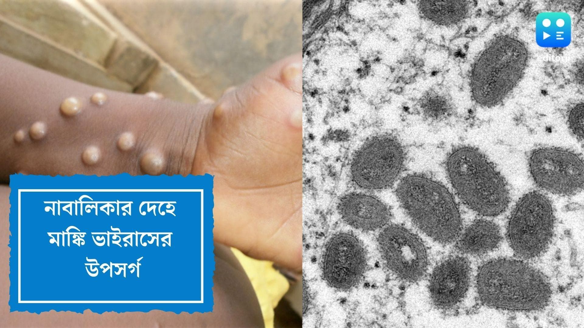 Monkey Pox Symptoms:ভারতেও কি মাঙ্কি ভাইরাস? নাবালিকার নমুনা পাঠানো হল পরীক্ষার জন্য