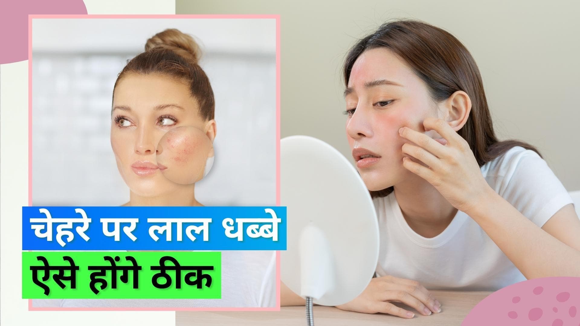 Facial Redness: गर्मी में हो जाते हैं चेहरे पे लाल धब्बे, इससे राहत दिलाएंगे ये घरेलू उपाय