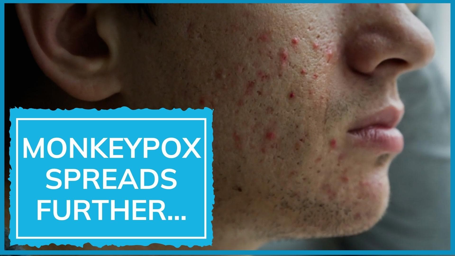 Monkeypox reaches Germany, France, Belgium; WHO calls for emergency meet