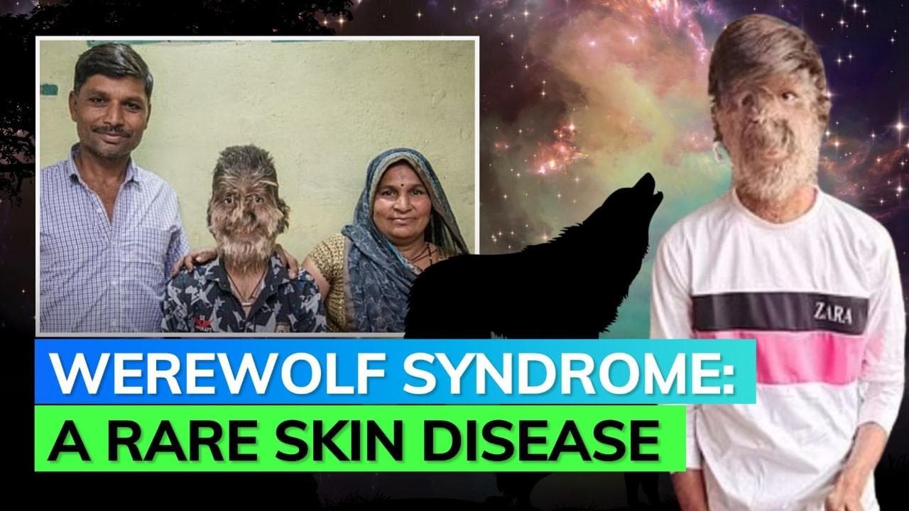 Madhya Pradesh boy shares his experience of living with werewolf syndrome; know more about it