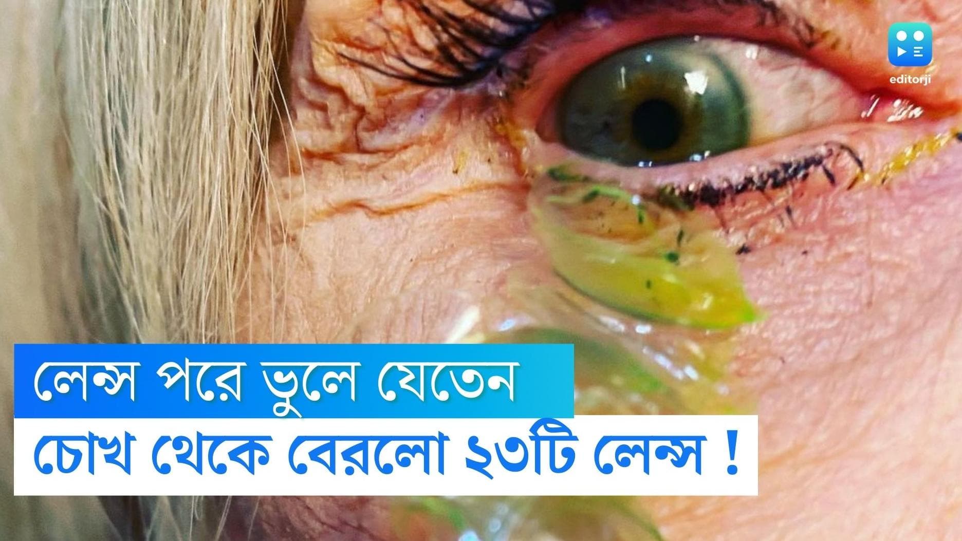  Contact Lense viral news : লেন্স পরে ভুলে যেতেন, মহিলার চোখ থেকে বেরলো ২৩টি কন্ট্যাক্ট লেন্স
