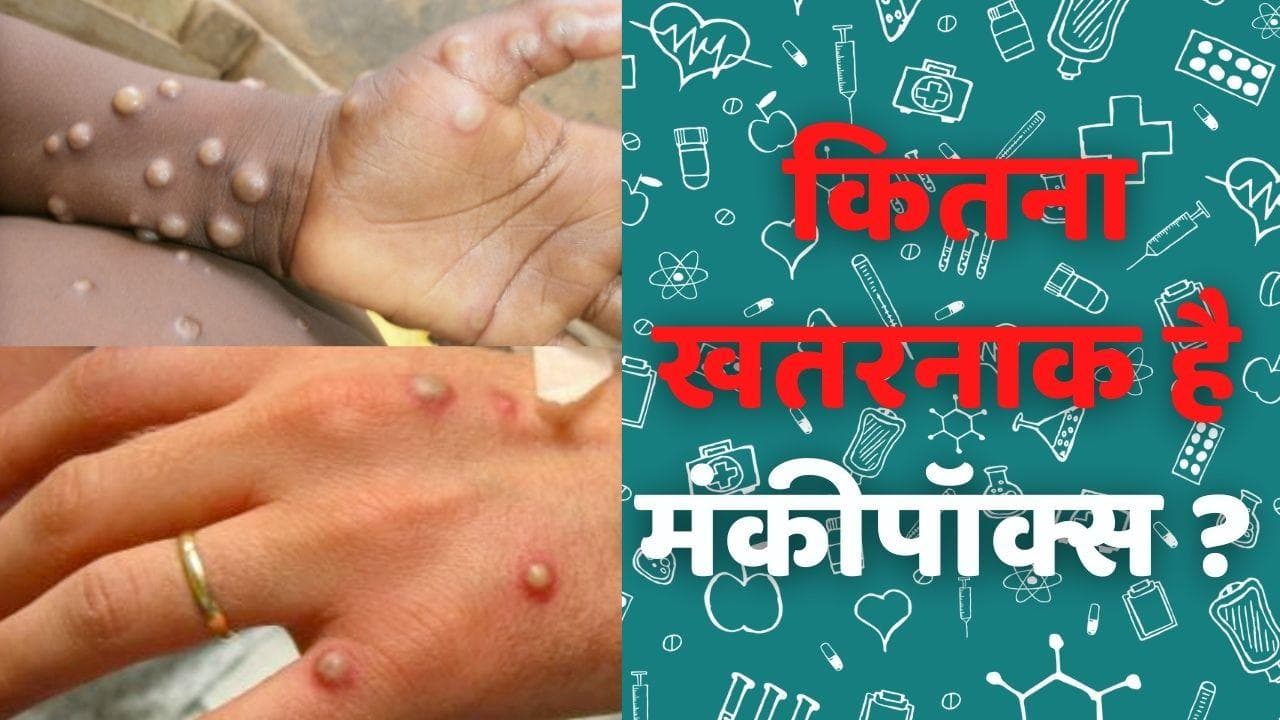MonkeyPox Virus: इंसानों में आई बंदर वाली बीमारी, जानें क्या है ये नई प्रॉब्लम