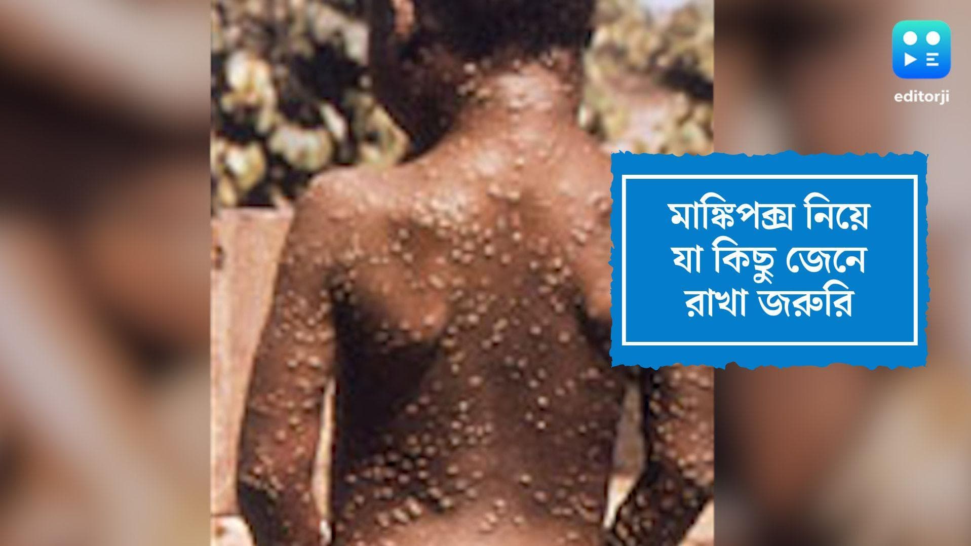 Monkey Pox virus: মাঙ্কিপক্স ভাইরাস নিয়ে সতর্ক হোন এখন থেকেই, জেনে নিন এই সব জরুরি তথ্য
