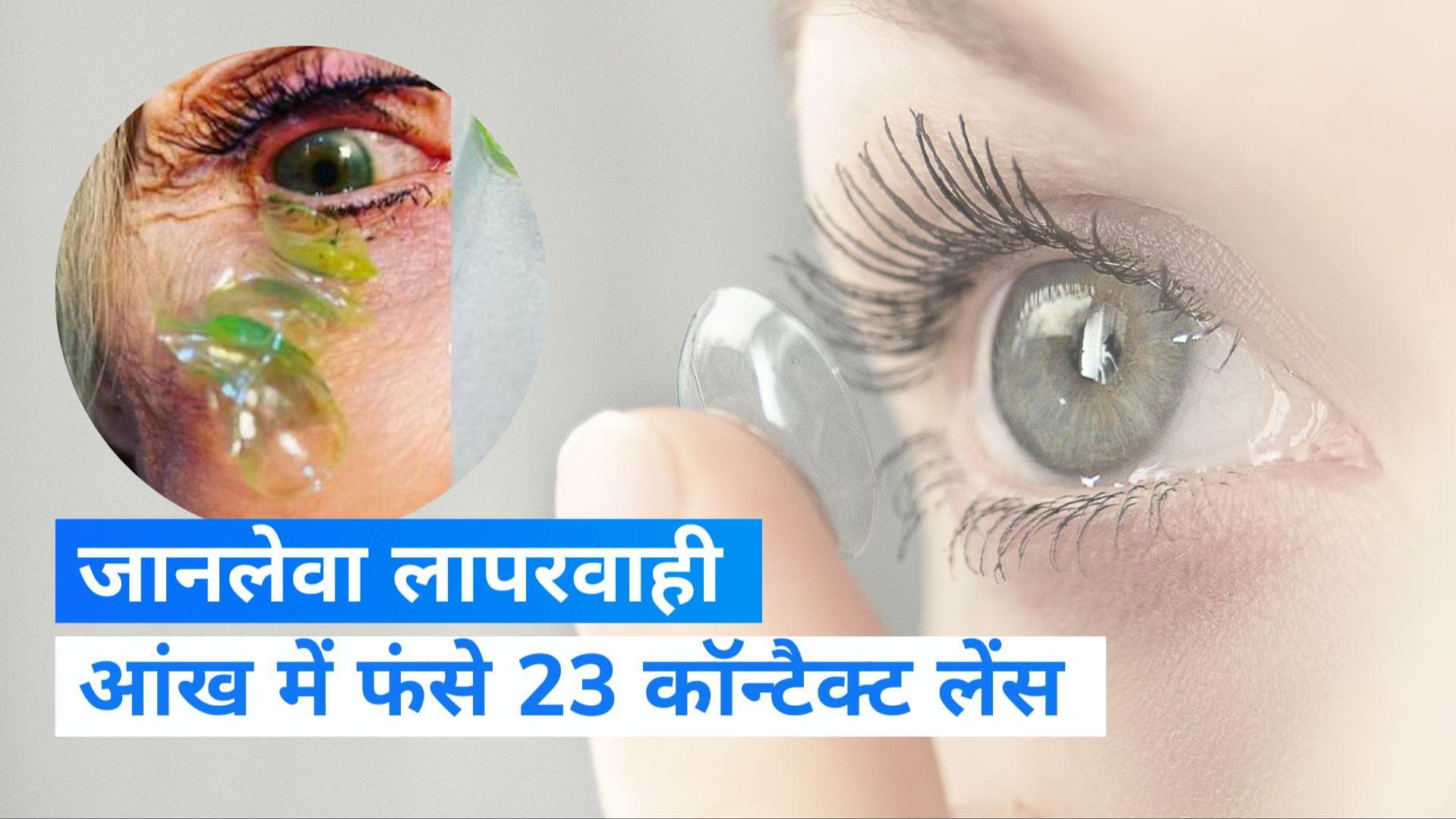 Viral Video: डॉक्टर ने महिला की आंखों से निकाले 23 कॉन्टैक्ट लेंस, वजह जान सिर पकड़ लेंगे आप
