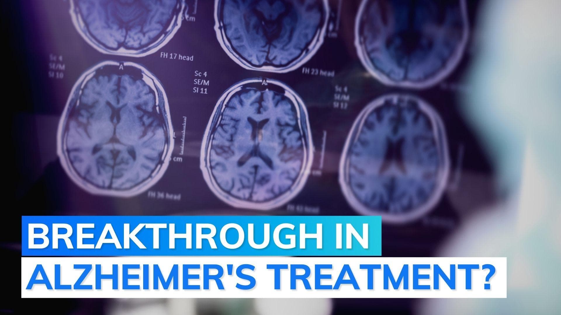 Experimental Alzheimer's drug renews hope, relatively slows down worsening of disease 