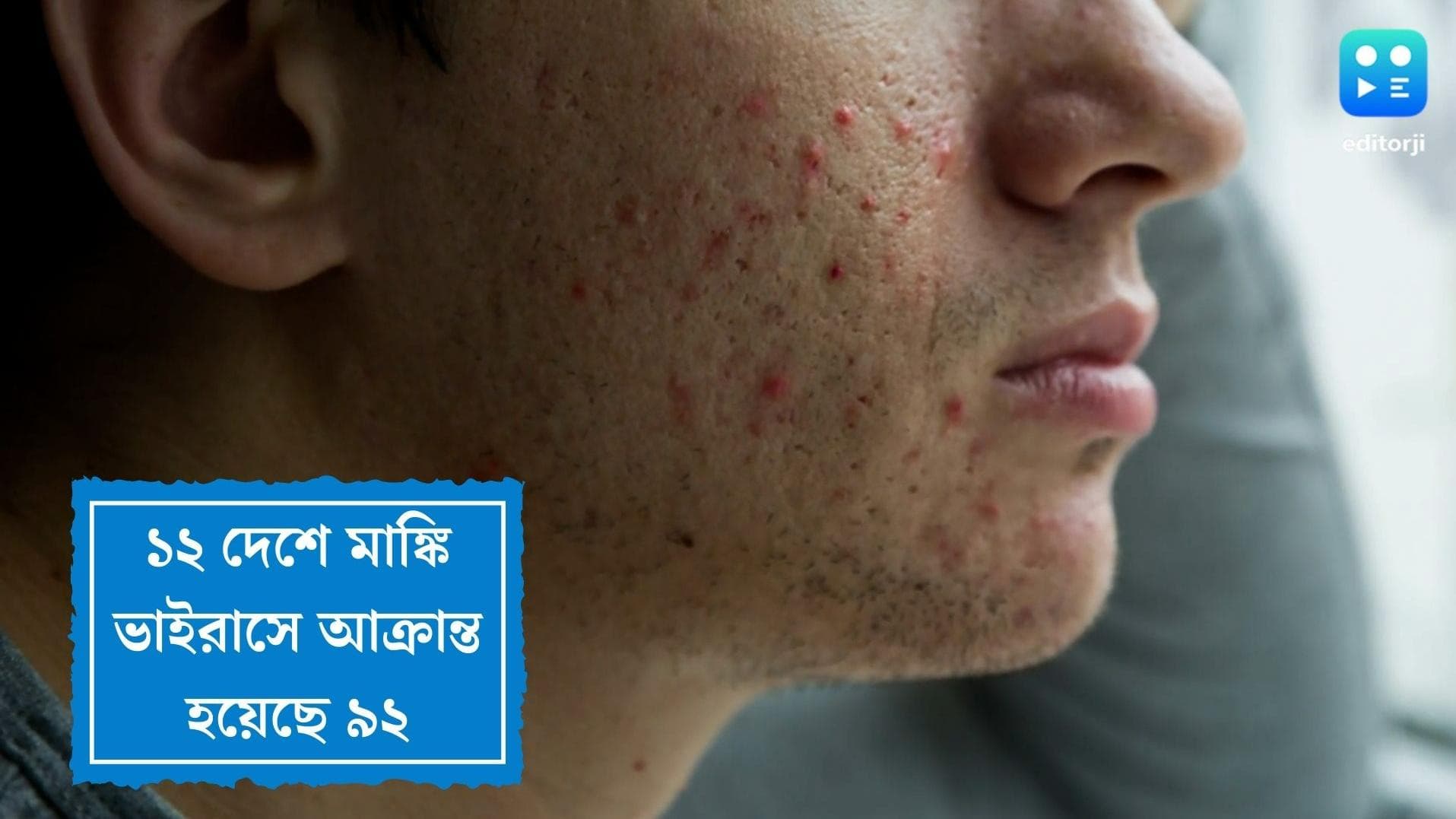 Monkey Virus Spreading: ১২ দেশে মাঙ্কি ভাইরাসে আক্রান্ত ৯২, সংক্রমণ আরও বাড়বে জানাল ‘হু’