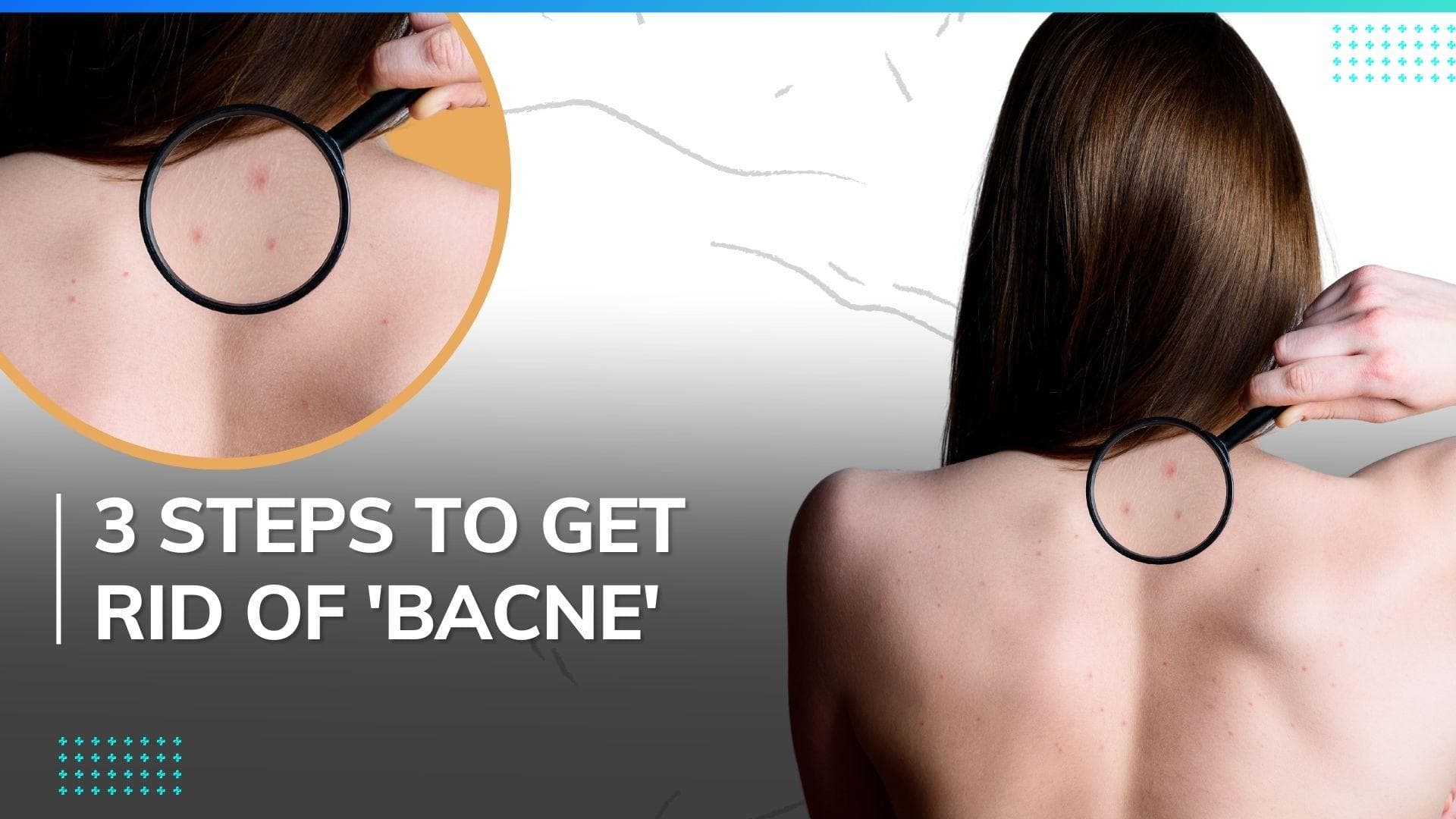 Get rid of those back acnes! Dermatologist suggests 3 ways for an acne-free life