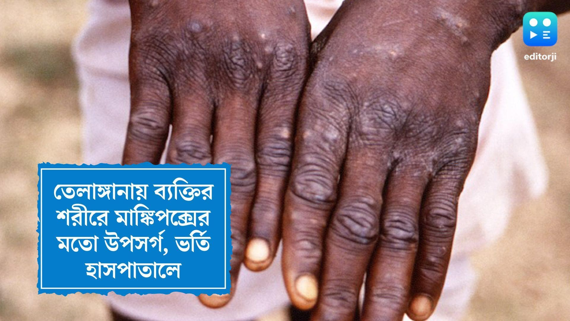 Monkey Pox in Telangana: শরীরে মাঙ্কিপক্সের মতো উপসর্গ, সম্প্রতি কুয়েত থেকে ফিরেছেন তেলাঙ্গানার ব্যক্তি