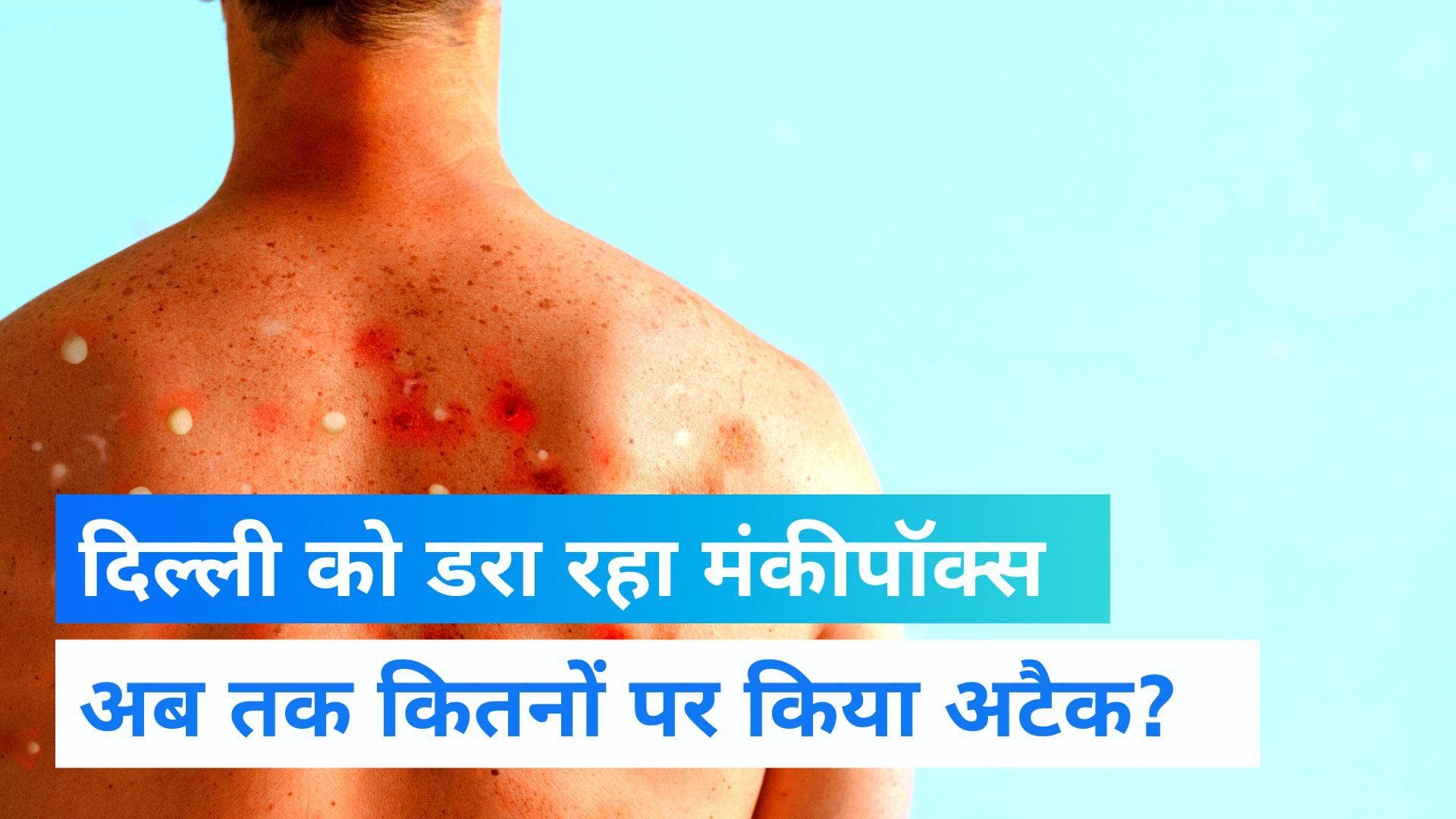 Monkeypox in Delhi: राजधानी पर मंकीपॉक्स का एक और अटैक, ट्रैवल हिस्ट्री नहीं फिर भी मिला दूसरा केस