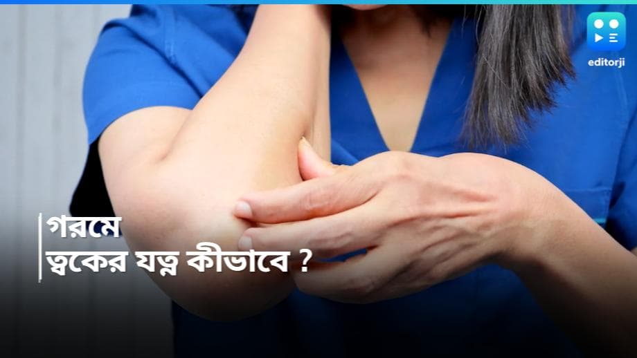 Skin Care in Summer : গরমে ঘামাচি বা ব়্যাশের জ্বালায় ত্বক জ্বলছে ? মেনে চলুন এই ঘরোয়া টোটকাগুলি