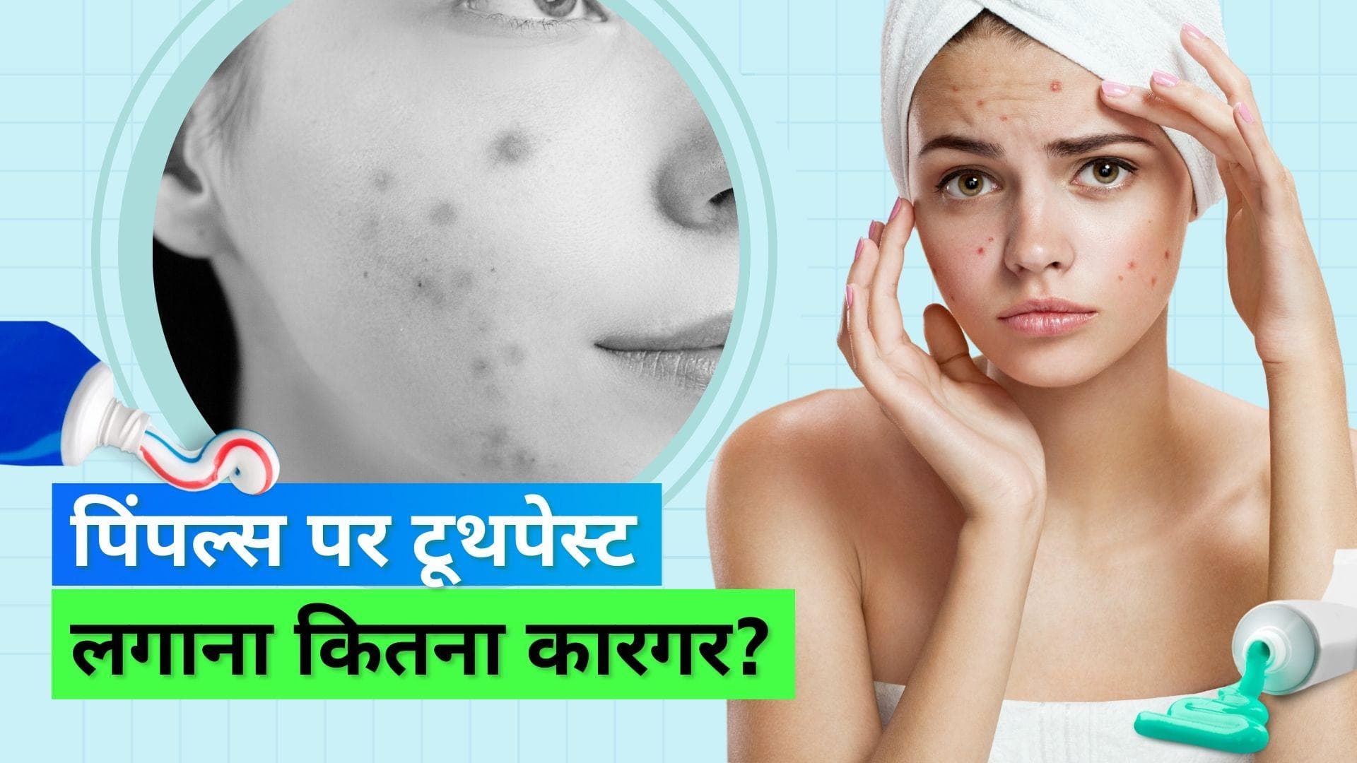 Toothpaste for Pimples: पिंपल्स पर टूथपेस्ट लगाने से पहले एक बार सोच लें, लग सकती है और पिंपल्स की झड़ी