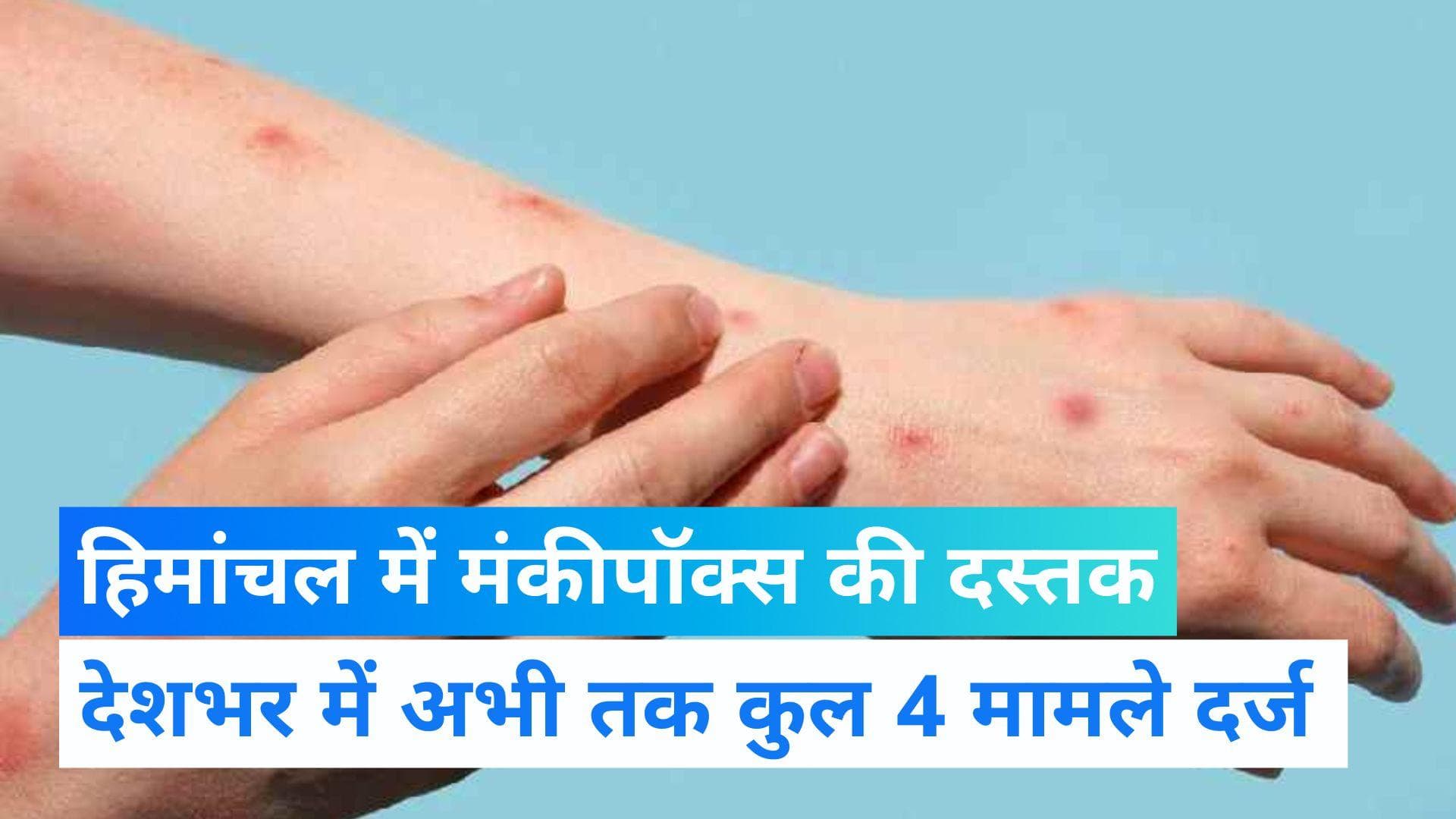 Monkeypox Virus : हिमाचल प्रदेश से आया मंकीपॉक्स का ताजा मामला