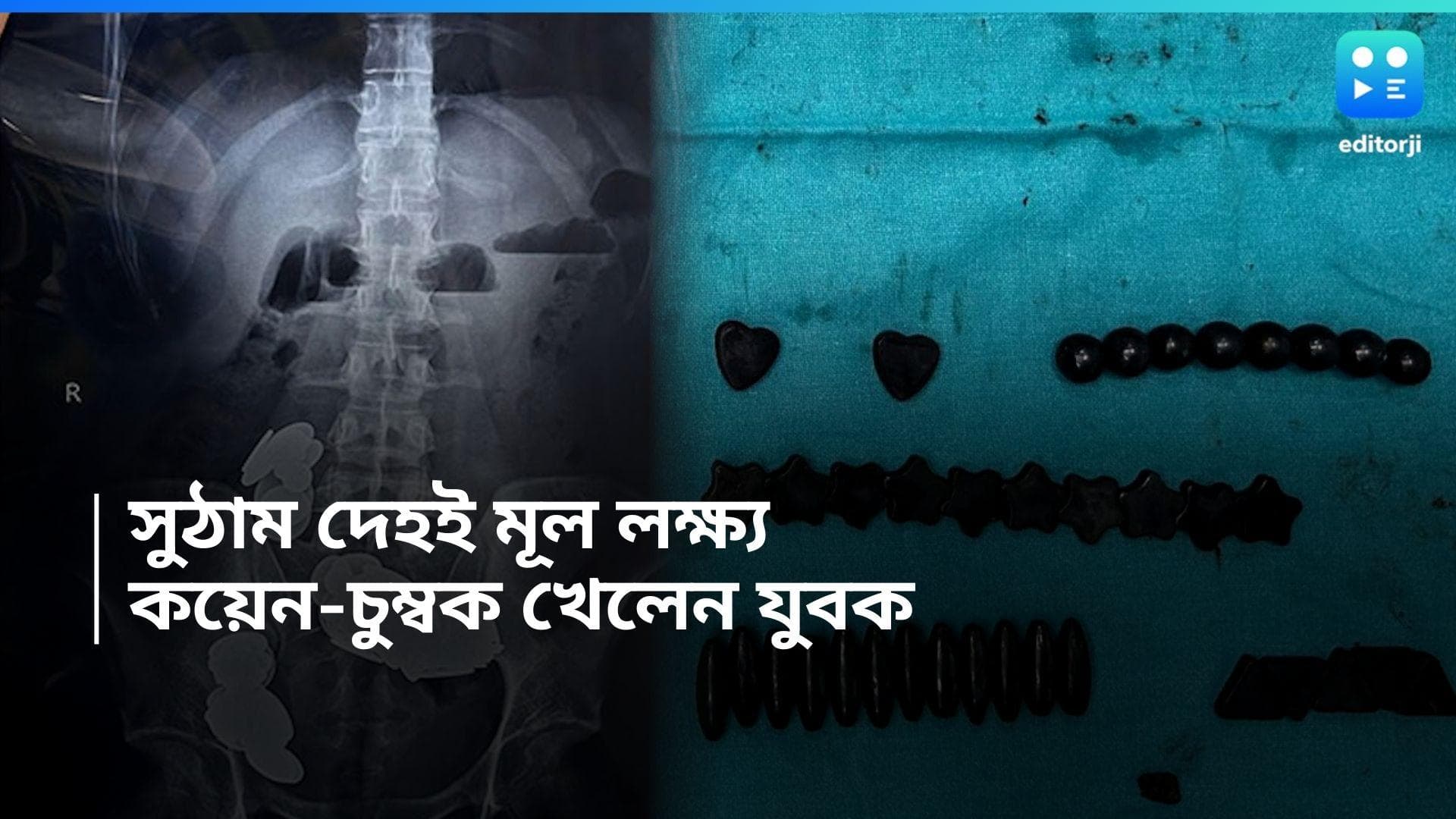 Man swalloed coins and magnets: শরীর 'সুঠাম' রাখতে বহু কয়েন ও চুম্বক খেয়ে নিলেন যুবক, স্তম্ভিত চিকিৎসকরা