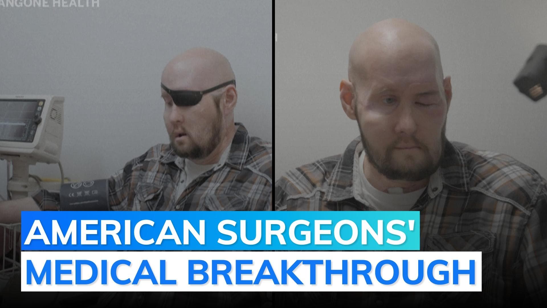 World's first whole eye transplant done in US