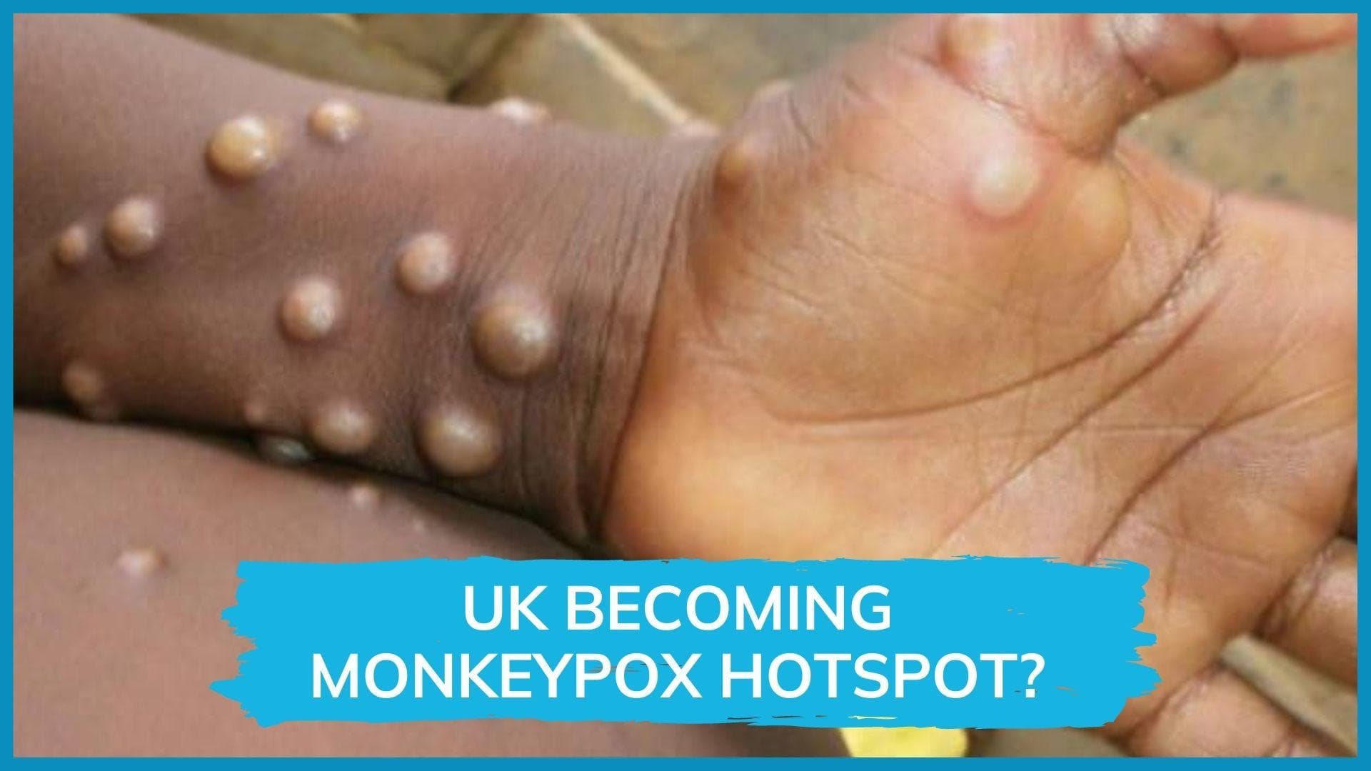 UK: 77 new monkeypox cases, biggest outbreak outside Africa
