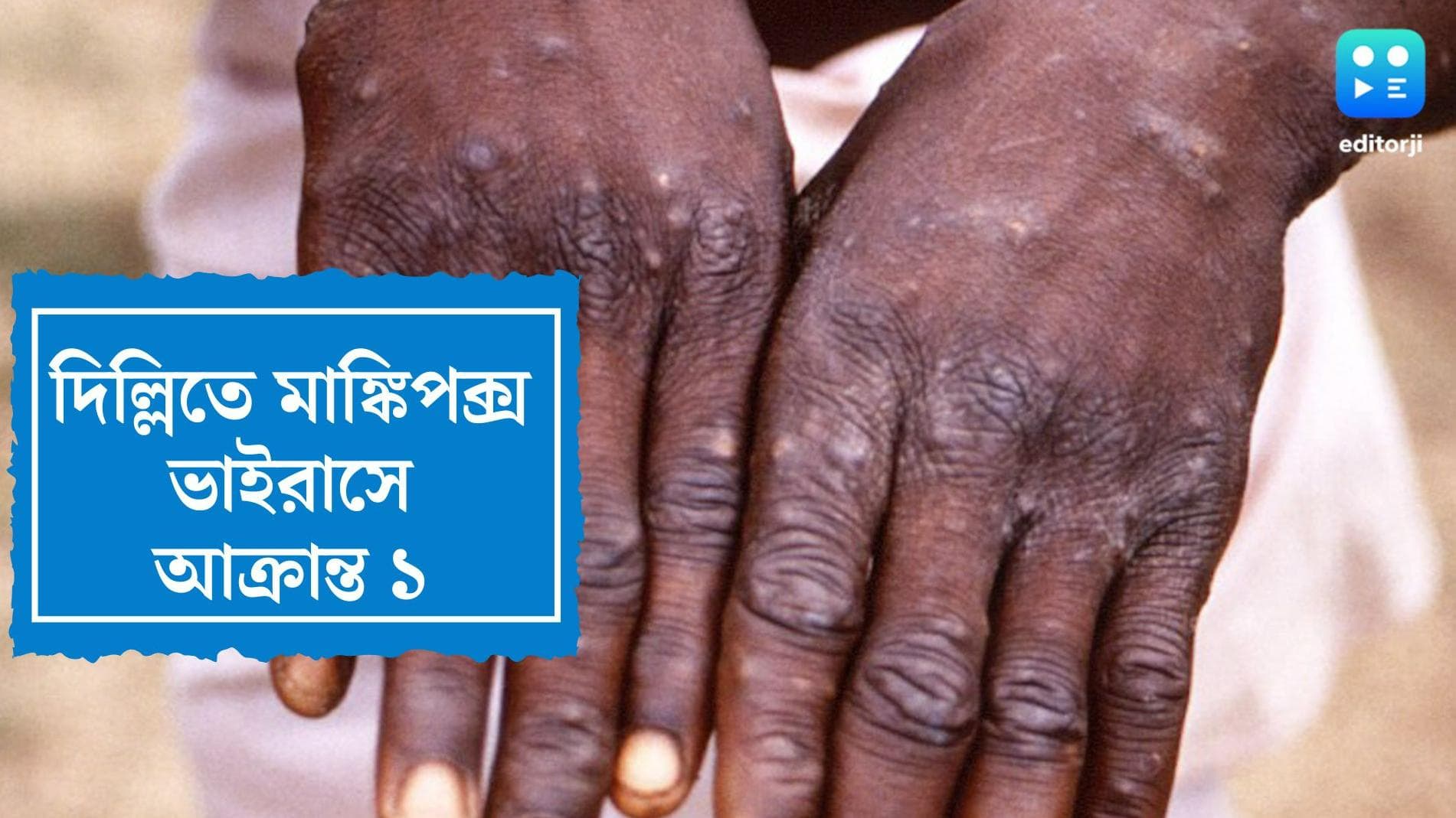 Delhi Monkeypox Virus News: কেরালার পর এবার দিল্লি, বিদেশে না গিয়েও মাঙ্কিপক্সে আক্রান্ত এক ব্যক্তি