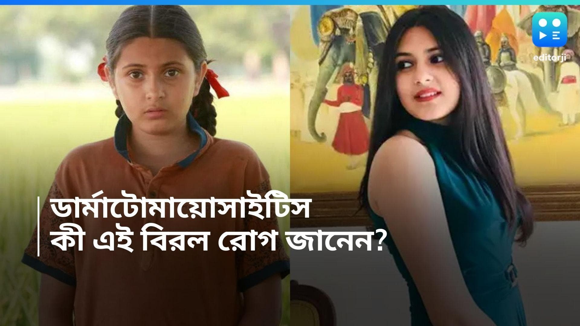 Dermatomyositis : ডার্মাটোমায়োসাইটিসে আক্রান্ত হয়ে মারা গিয়েছেন 'দঙ্গল' অভিনেত্রী, কী এই রোগ জানেন? 