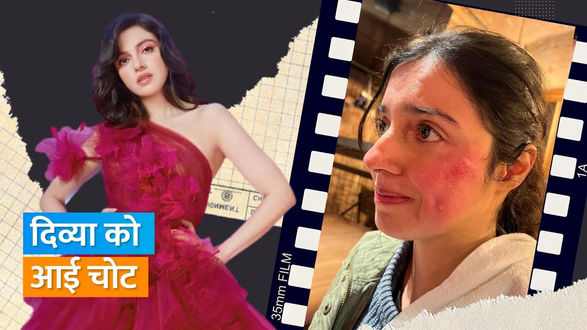 Divya Khosla Kumar शूटिंग के दौरान हुई घायल, एक्ट्रेस के चेहरे पर आई चोट