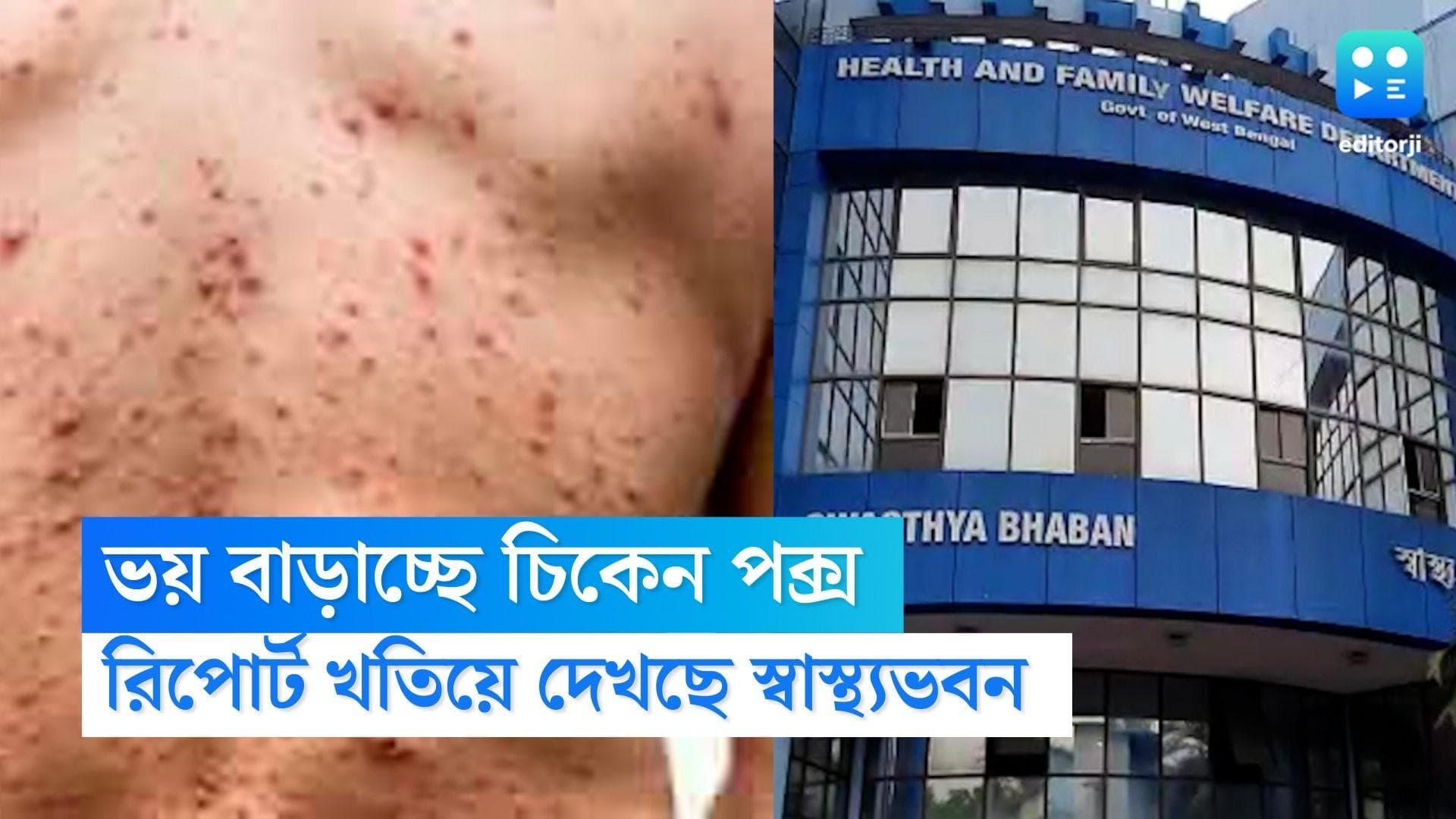 Chicken Pox: বাড়ছে চিকেন পক্স, মৃত্যুর সংখ্যা রীতিমতো ভাবাচ্ছে স্বাস্থ্য মহলকে
