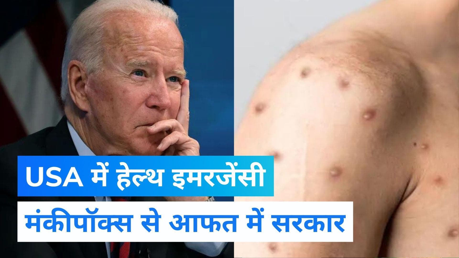 USA health emergency : तेज़ी से बढ़ते मंकीपॉक्स मामले को लेकर अमेरिका ने जताई चिंता, लगाई हेल्थ इमरजेंसी
