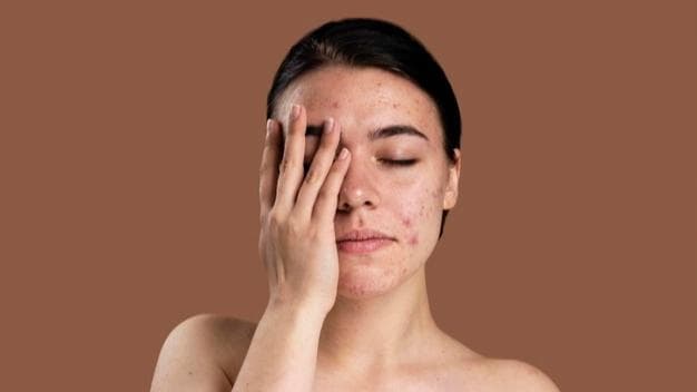 Skin breakouts driving you crazy? Top expert tips to prevent blackheads