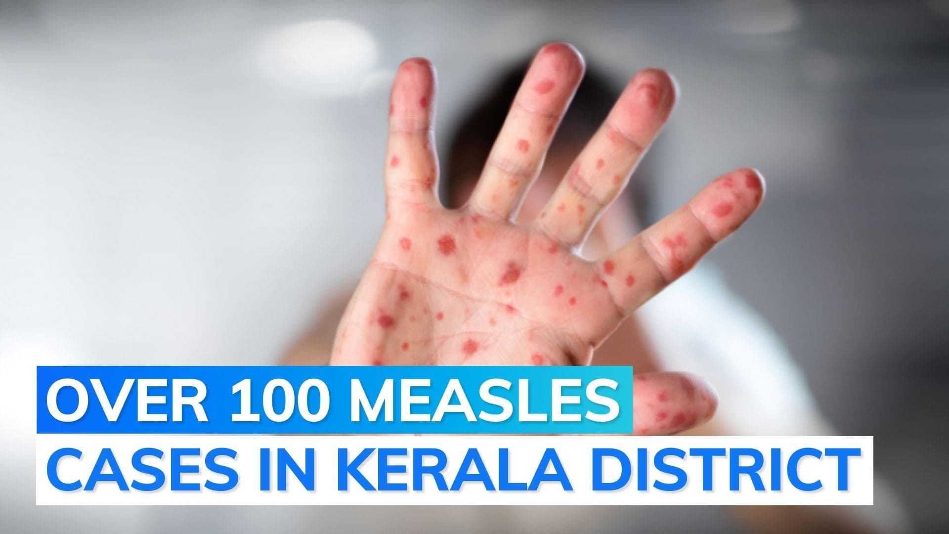 Rise in measles cases: Kerala govt urges children to get vaccination
