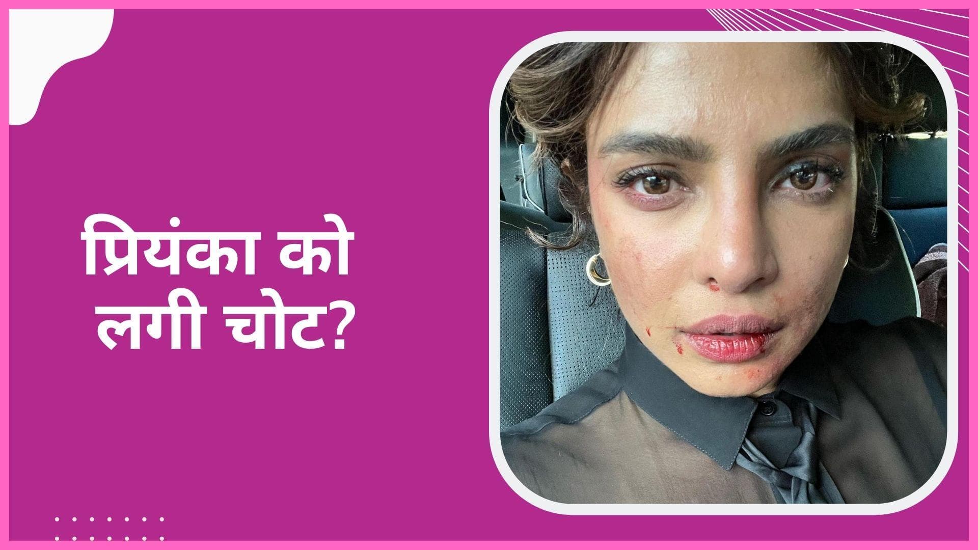 Priyanka Chopra को आई शूटिंग के दौरान फेस पर चोट? एक्ट्रेस की फोटो देख हैरान हुए फैंस 