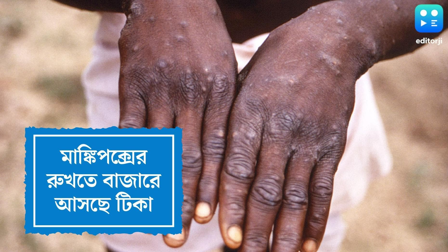 Monkey Pox Vaccine : মাঙ্কিপক্সের টিকায় অনুমতি ইউরোপীয় ইউনিয়নের