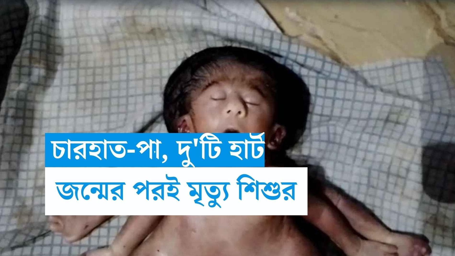 Baby with 4 arms,legs: চার হাত-পা, দুটি হার্ট নিয়ে জন্ম নিল শিশুকন্যা, কিছুক্ষণের মধ্যেই মৃত্যু সদ্যোজাতর