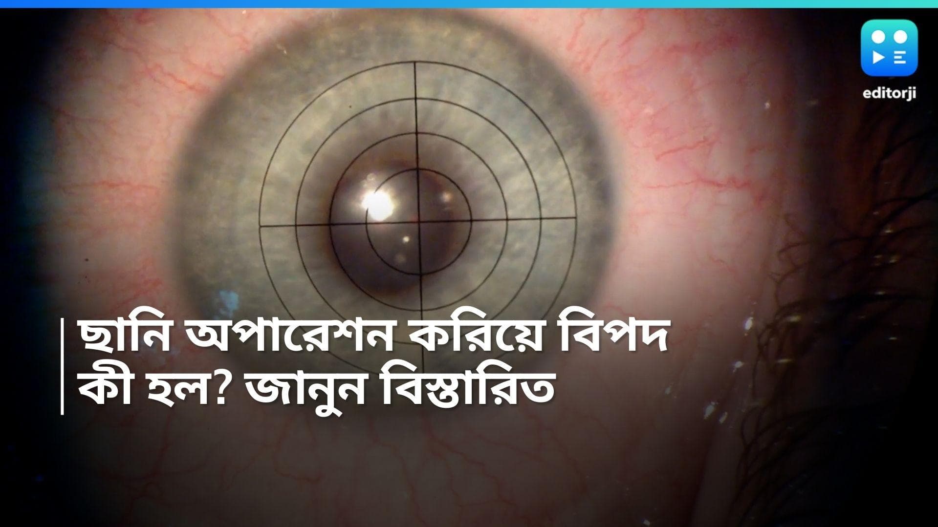 Eye Surgery: ছানি অপারেশন করিয়ে দেখতে পাচ্ছেন না ২৫ রোগী, সরকারি হাসপাতালের বিরুদ্ধে মারাত্মক অভিযোগ