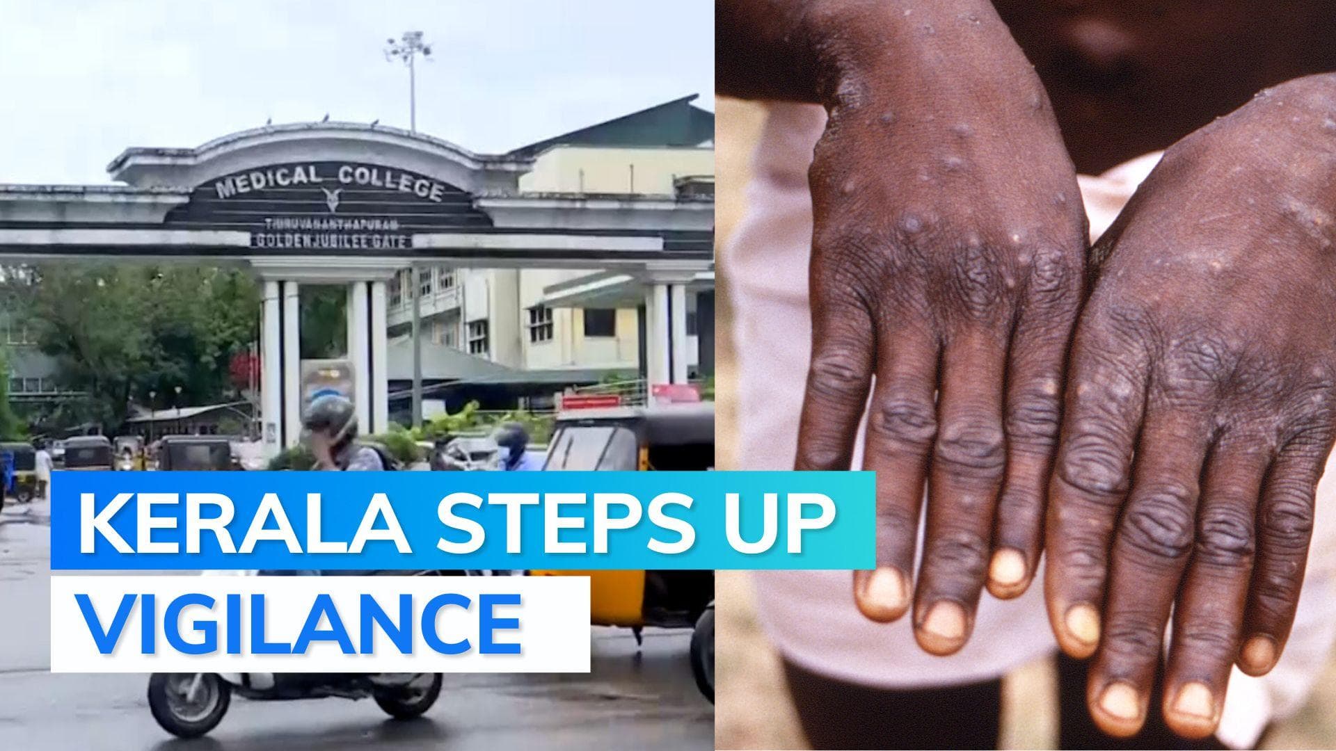 Monkeypox: Kerala starts contact tracing, issues special alerts to 5 districts