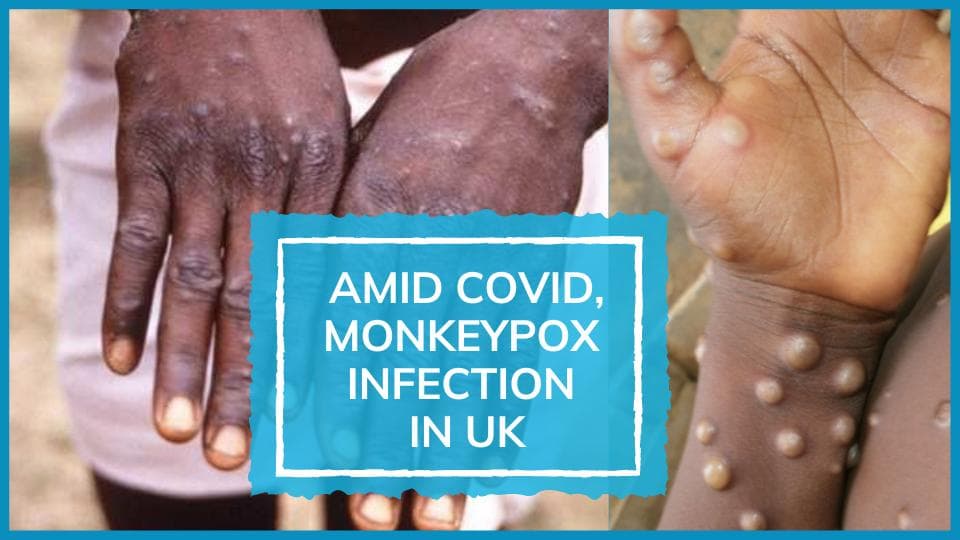 Monkeypox virus infection reported in UK amid Covid: see how it spreads, symptoms