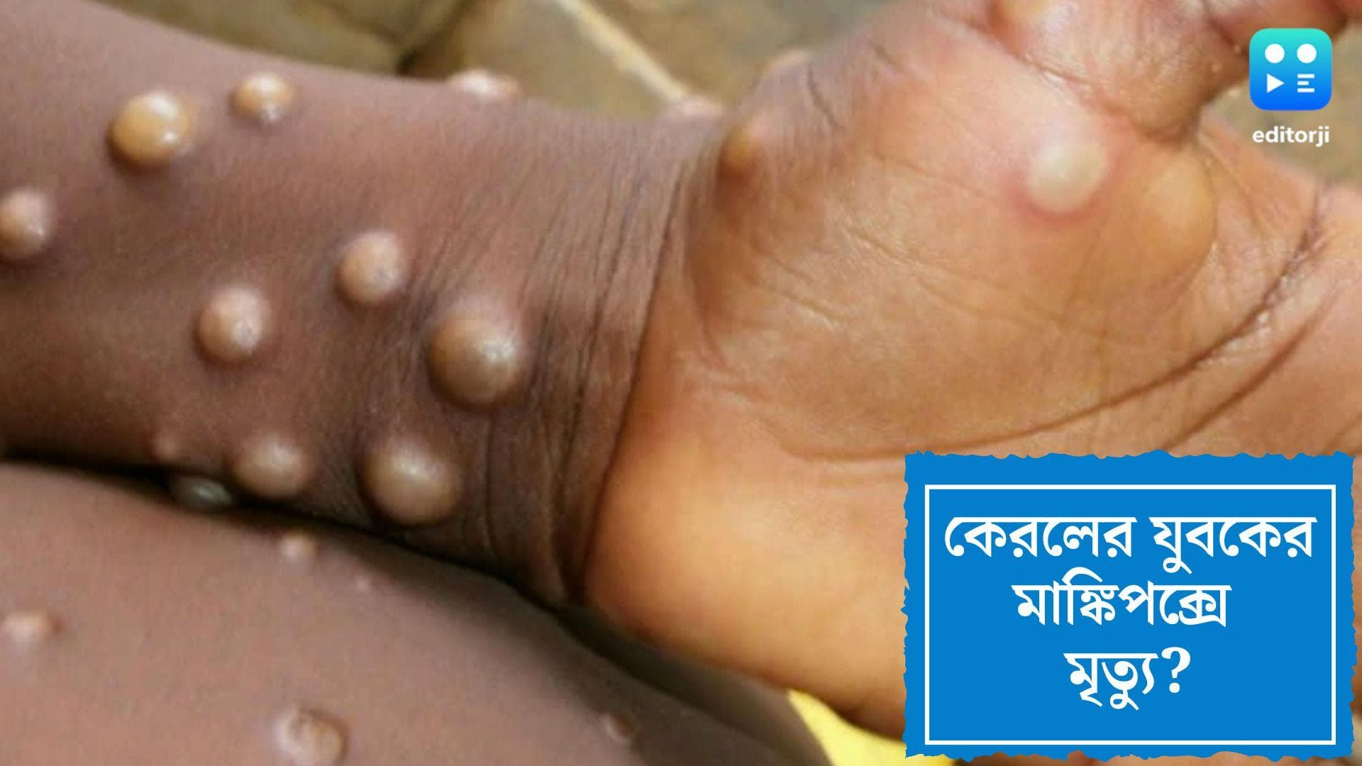 Monkeypox:কেরলে যুবকের মাঙ্কিপক্সে মৃত্যু? নমুনা পরীক্ষার জন্য় পাঠানো হল