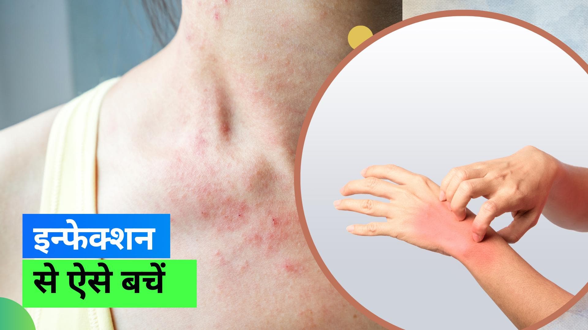 Skin Infection: बारिश के गंदे पानी से हो रहा है स्किन इन्फेक्शन, इन टिप्स से फंगल को रखें दूर 