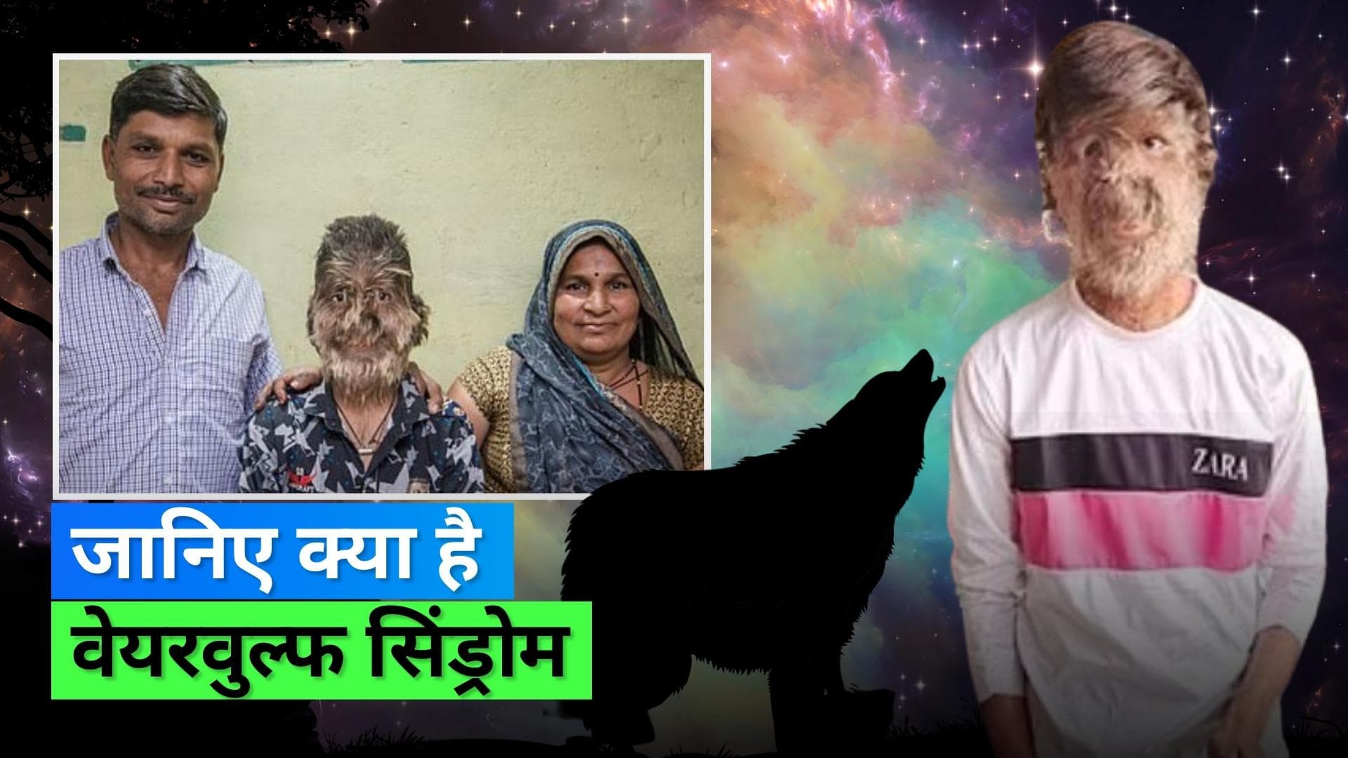 मध्य प्रदेश के लड़के के पूरे चेहरे पर है कही ज़्यादा बाल, 'Werewolf Syndrome' नामक है दुर्लभ बीमारी