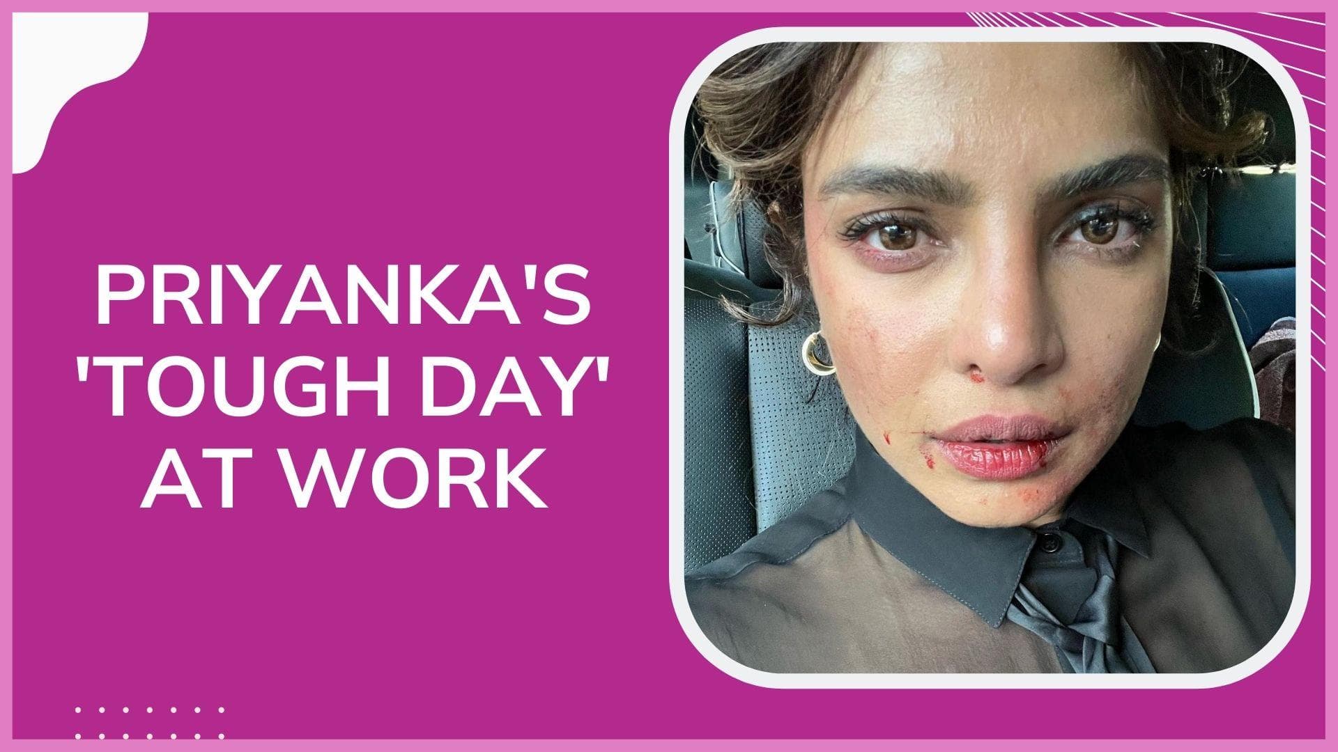 Priyanka Chopra leaves fans worried with pic of her bruised face