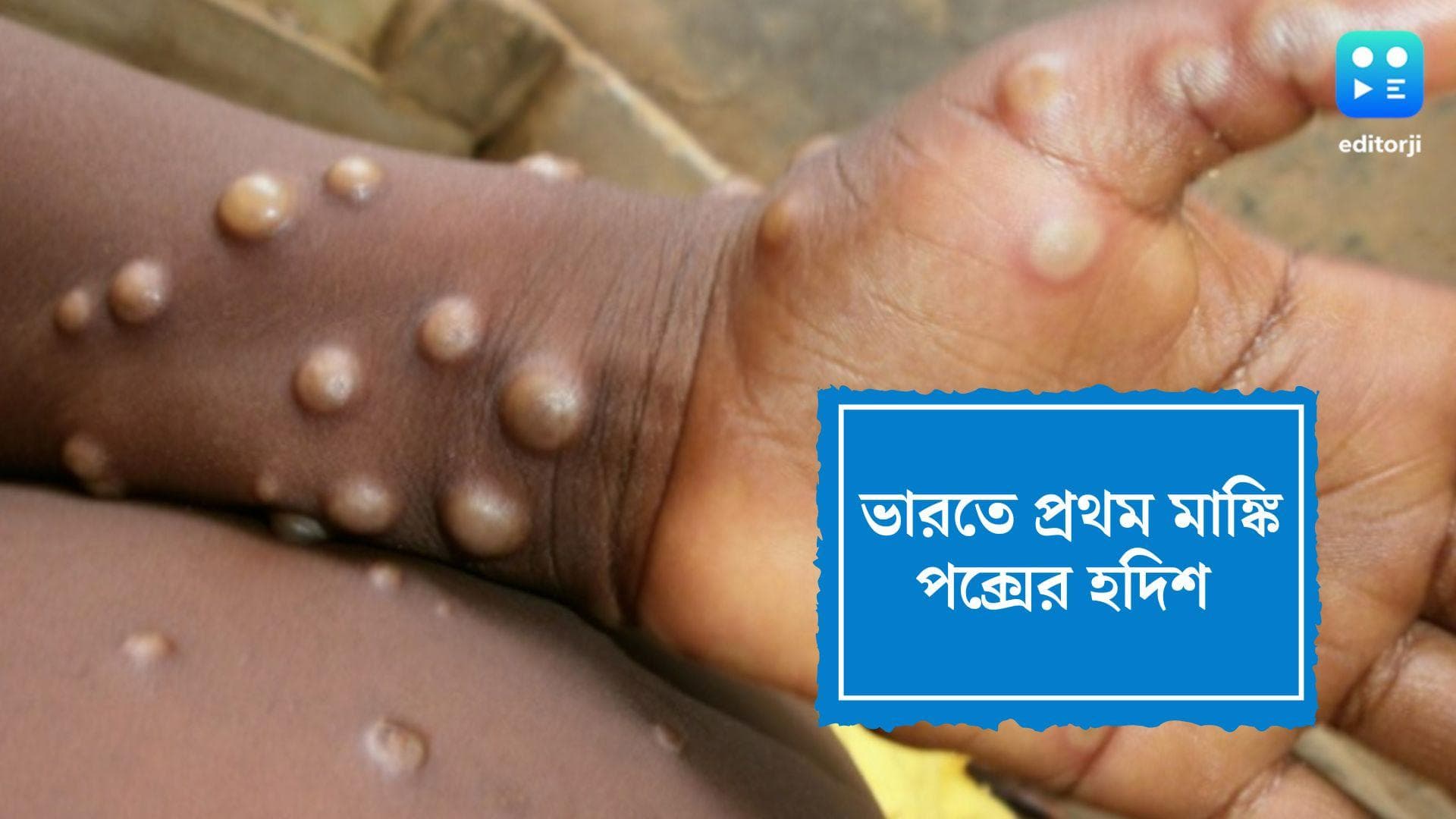 First Monkey pox case in India: প্রথম মাঙ্কি পক্স আক্রান্তের হদিশ মিলল ভারতে 