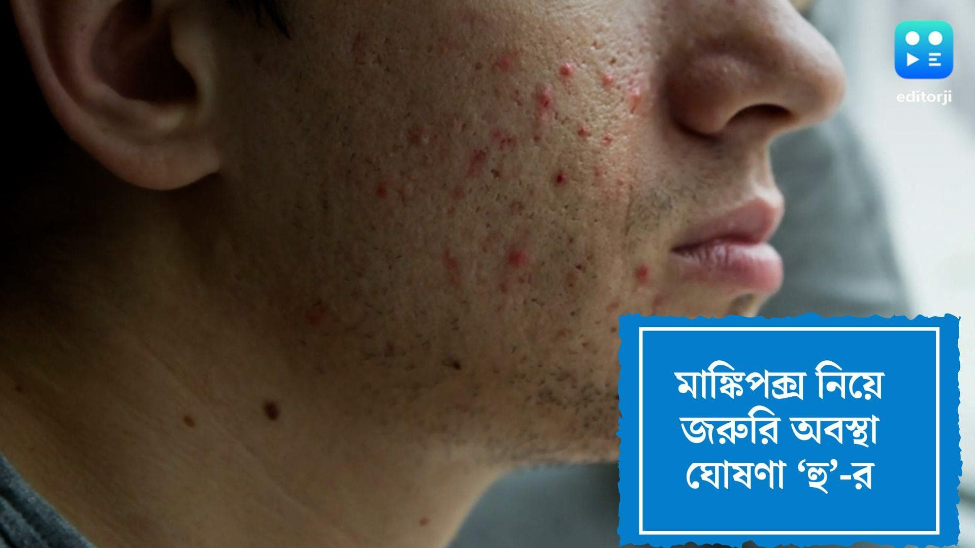 monkeypox:মাঙ্কিপক্স এক ‘বিশ্বব্যাপী জরুরি অবস্থা’, ঘোষণা করল WHO